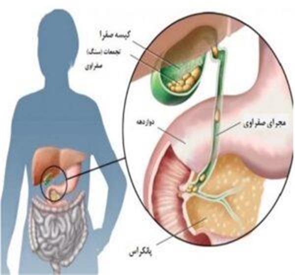کله سیستکتومی و مراقبتهای مربوطه