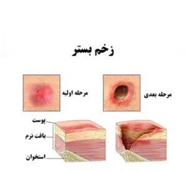 درمان در زخم های فشاری