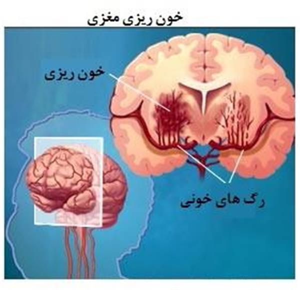 صدمات مغزی و درمان ها و مراقبتها