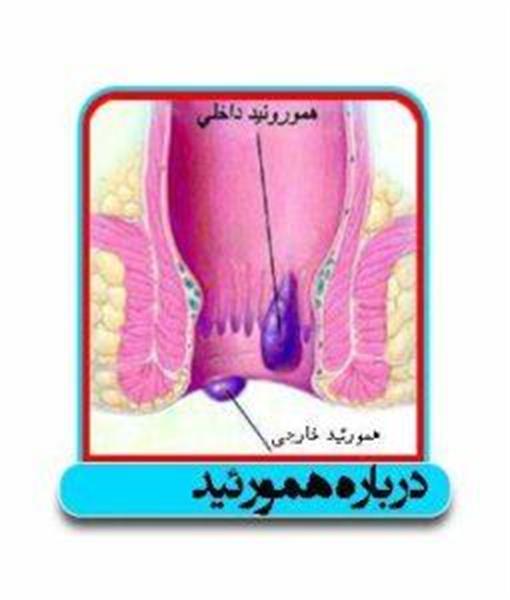 هموروئید