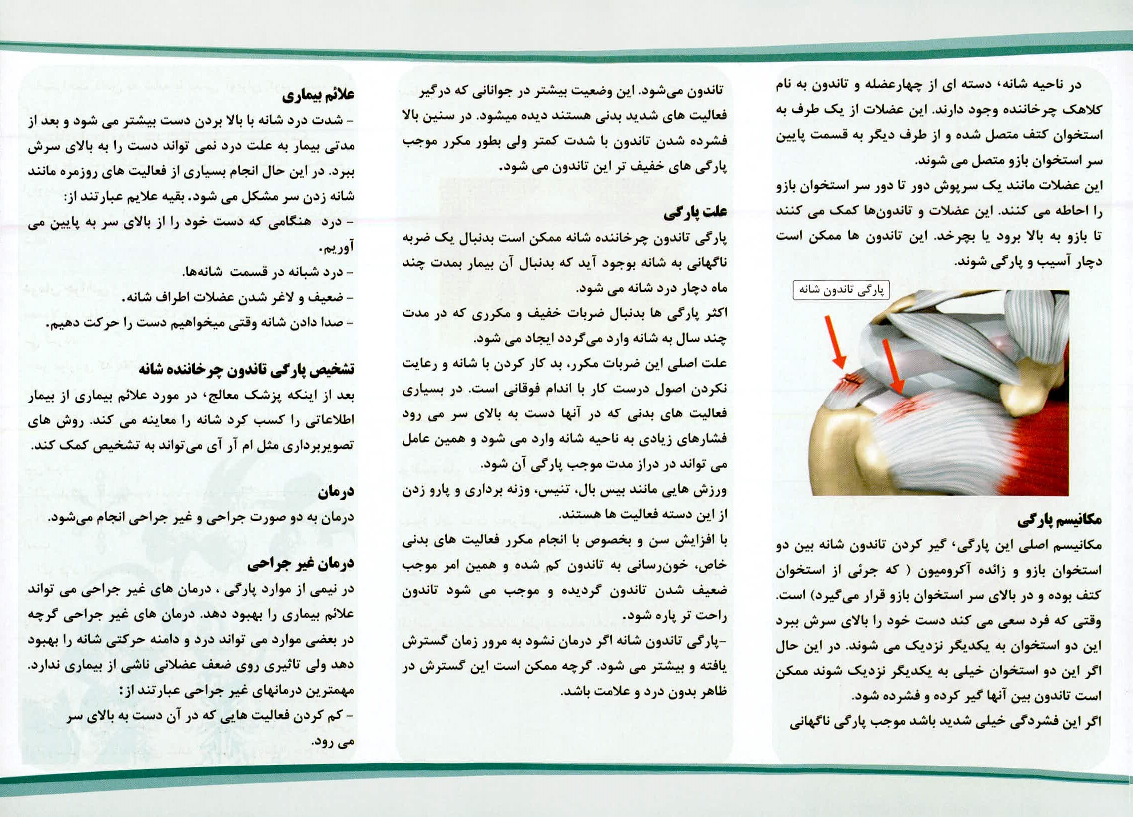 پارگی تاندون شانه