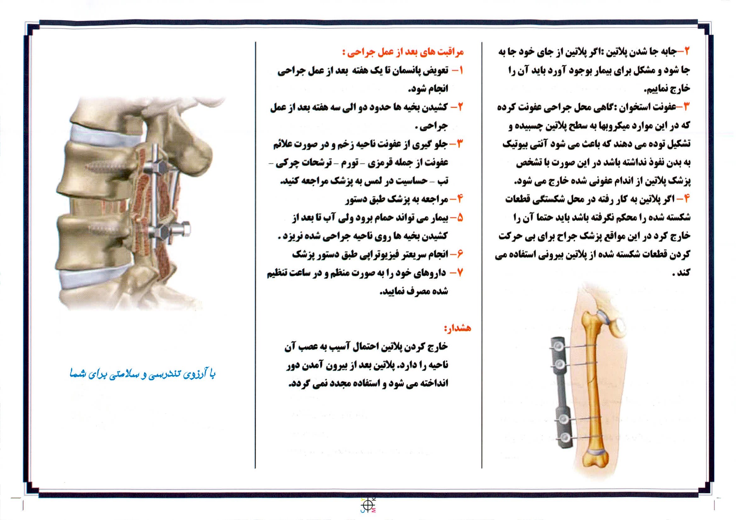 خارج کردن پلاتین